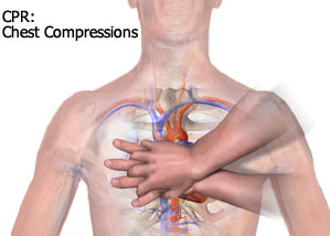 Chest Compressions