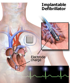 Manual defibrillators